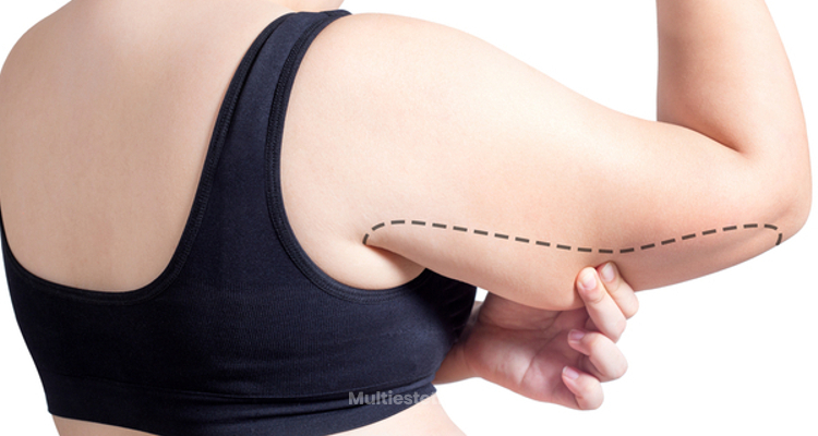 ¿Es la liposucción del brazo tan efectiva como la braquioplastia?