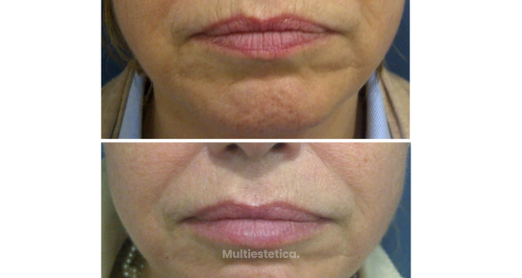 El rejuvenecimiento facial: la ciencia hecha arte