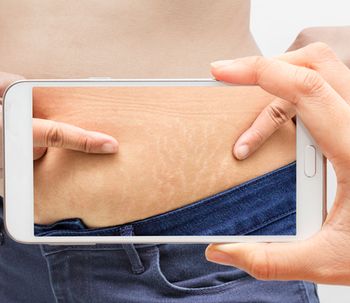 ¿Qué tratamiento para las estrías es eficaz?