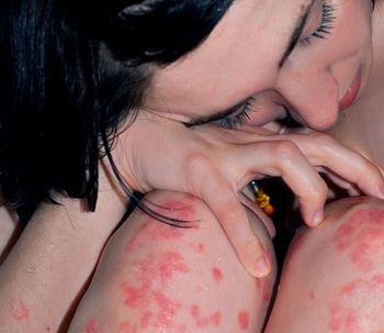 Tratamientos para aliviar la psoriasis
