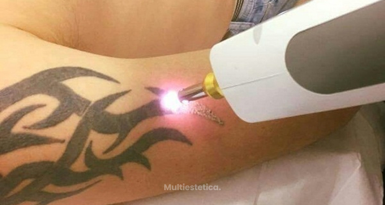 Eliminación de Tatuajes, todo lo que debes saber