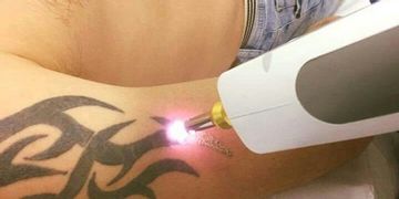 Eliminación de Tatuajes, todo lo que debes saber