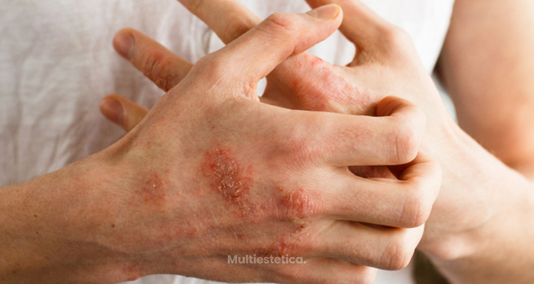 Dermatitis: ¿cuántos tipos hay?