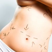 Las cicatrices de la abdominoplastia pueden ocultarse