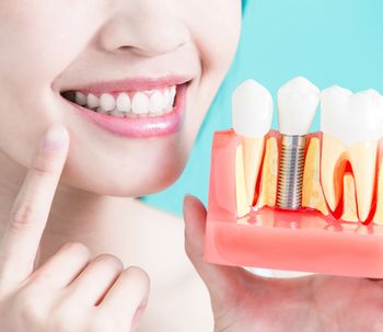 ¿Qué son los Implantes de carga inmediata?