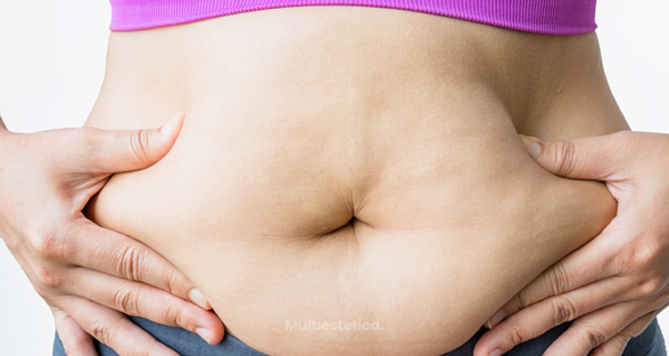 Tipos de abdominoplastia: ¿cuál es la más acertada en cada caso?