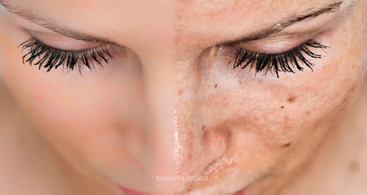 ¿Cómo eliminar las manchas solares despues del verano?