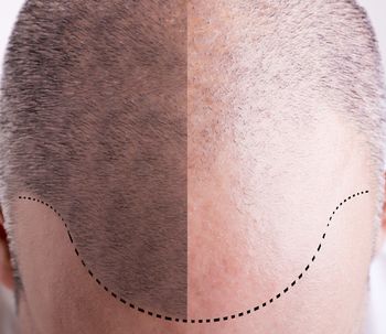 Cómo es el paso a paso de un trasplante de cabello