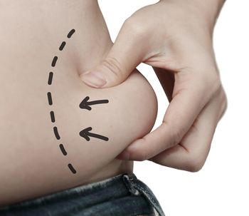 Cómo eliminar las «orejas de perro» tras una abdominoplastia