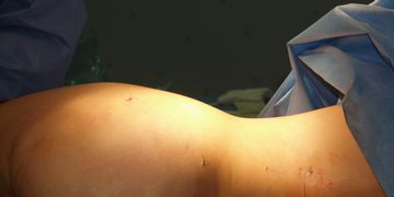 VASERlipo: la nueva era en la cirugía de contorno VASERlipo: la nueva era en la cirugía de contorno