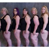 Dr. Xavier Armengou: ¿Qué es el lipedema?