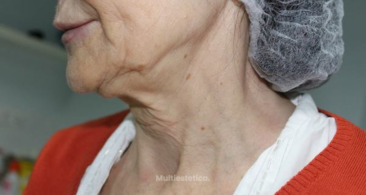 Lifting facial sin cirugía