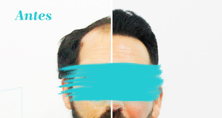 El auge del implante de pelo en el mundo