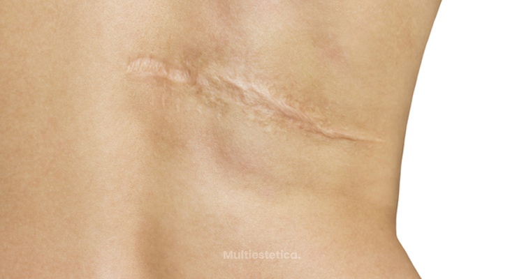 La T cnica Que Oculta Las Cicatrices Micropigmentaci n Multiestetica