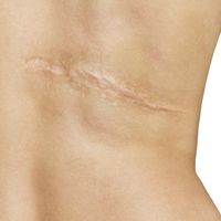 La técnica que oculta las cicatrices: Micropigmentación