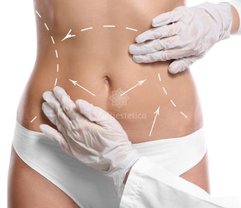 TruSculpt 3D, el tratamiento que elimina la grasa localizada