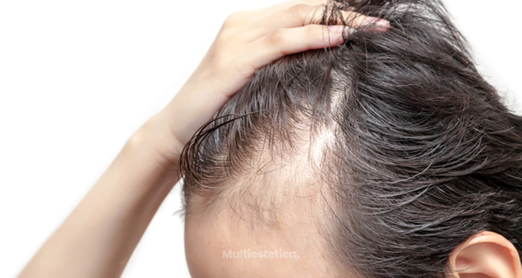 Mesoterapia, un tratamiento eficaz para combatir la alopecia