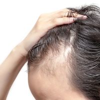 Mesoterapia, un tratamiento eficaz para combatir la alopecia