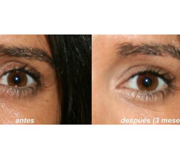 Rejuvenecimiento periorbitario con ácido hialurónico ¿cómo quitar las ojeras? ¿cómo eliminar los ojos hundidos?