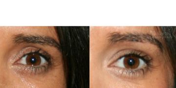 Rejuvenecimiento periorbitario con ácido hialurónico ¿cómo quitar las ojeras? ¿cómo eliminar los ojos hundidos?