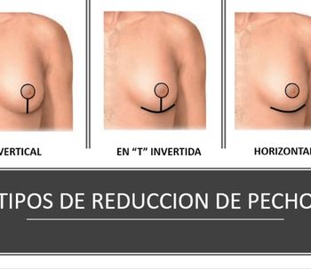 Entrevista reducción de pecho con Contour Clinic
