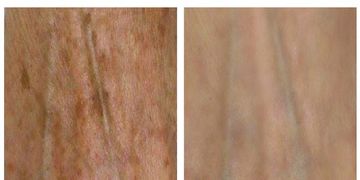 Manchas en la piel: El láser que las elimina y rejuvenece al mismo tiempo