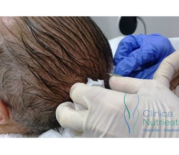 PRP (Plasma Rico en Plaquetas)