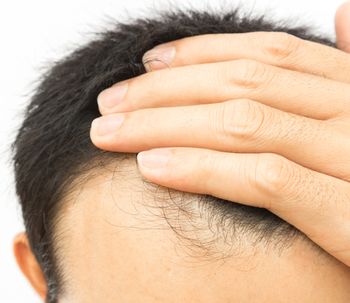 Recupera tu pelo gracias al trasplante capilar