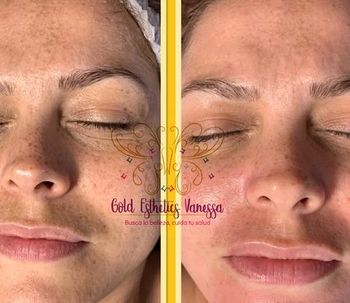 Conoce todos los beneficios del Peeling Dermapeel