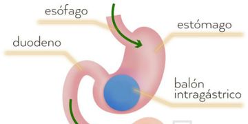 ¿Cómo funciona el balón intragástrico?