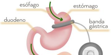 ¿Cómo funciona el tratamiento de banda gástrica?
