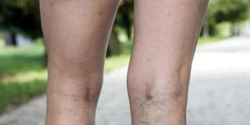¿Es mejor operar o pinchar las varices?