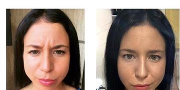 Qué debes saber sobre la Toxina Botulínica Tipo A o Botox
