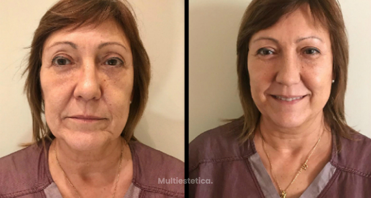 Hilos faciales, gran solución para rejuvenecer el rostro