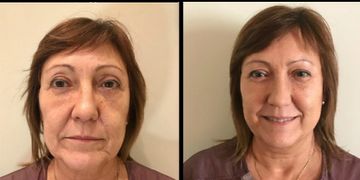 Hilos faciales, gran solución para rejuvenecer el rostro