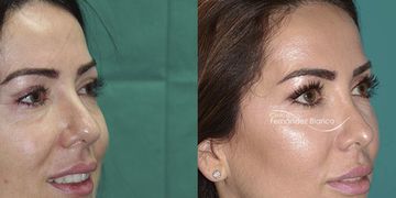 Rinoplastia Madrid