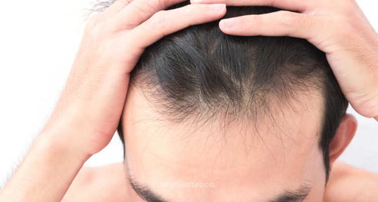 Combate la alopecia androgenética con microinyecciones de dutasterida