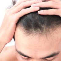 Combate la alopecia androgenética con microinyecciones de dutasterida