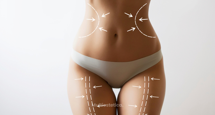 "La lipoescultura elimina la grasa de donde más nos molesta y de forma perdurable"