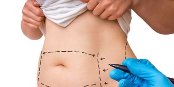Todo lo que debes saber sobre el postoperatorio de la abdominoplastia