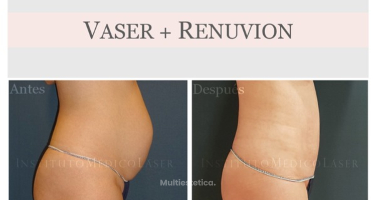 Lipo Vaser + Renuvion: técnica exclusiva en Madrid