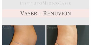 Lipo Vaser + Renuvion: técnica exclusiva en Madrid Lipo Vaser + Renuvion: técnica exclusiva en Madrid