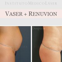 Lipo Vaser + Renuvion: técnica exclusiva en Madrid