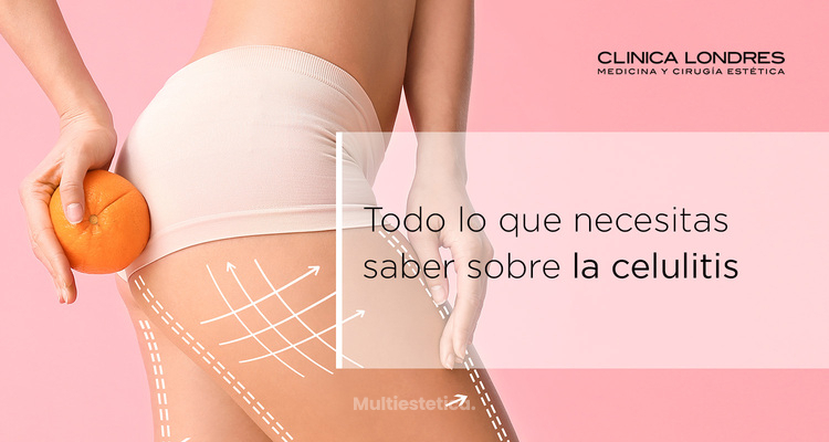 Todo lo que necesitas saber sobre la celulitis
