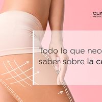 Todo lo que necesitas saber sobre la celulitis