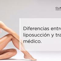 Diferencia entre liposucción y tratamientos médico estéticos corporales para reducir y remodelar, ¿cuáles son más efectivos?