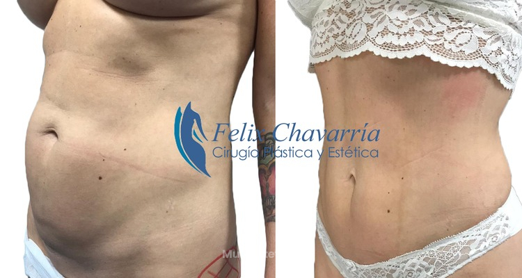 Lipo Vaser, la alternativa a la liposucción convencional