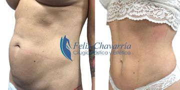Lipo Vaser, la alternativa a la liposucción convencional Lipo Vaser, la alternativa a la liposucción convencional