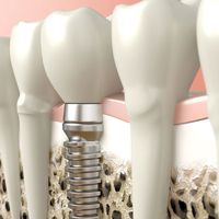 Implantes dentales: reemplazo de dientes