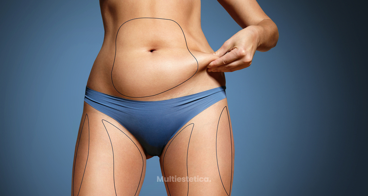 Elimina la grasa y remodela la silueta con la liposucción ultrasónica Safir CDC